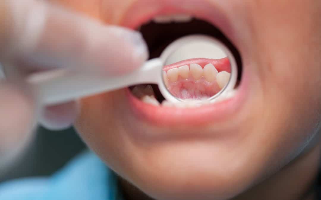Why Are Baby Teeth Important?