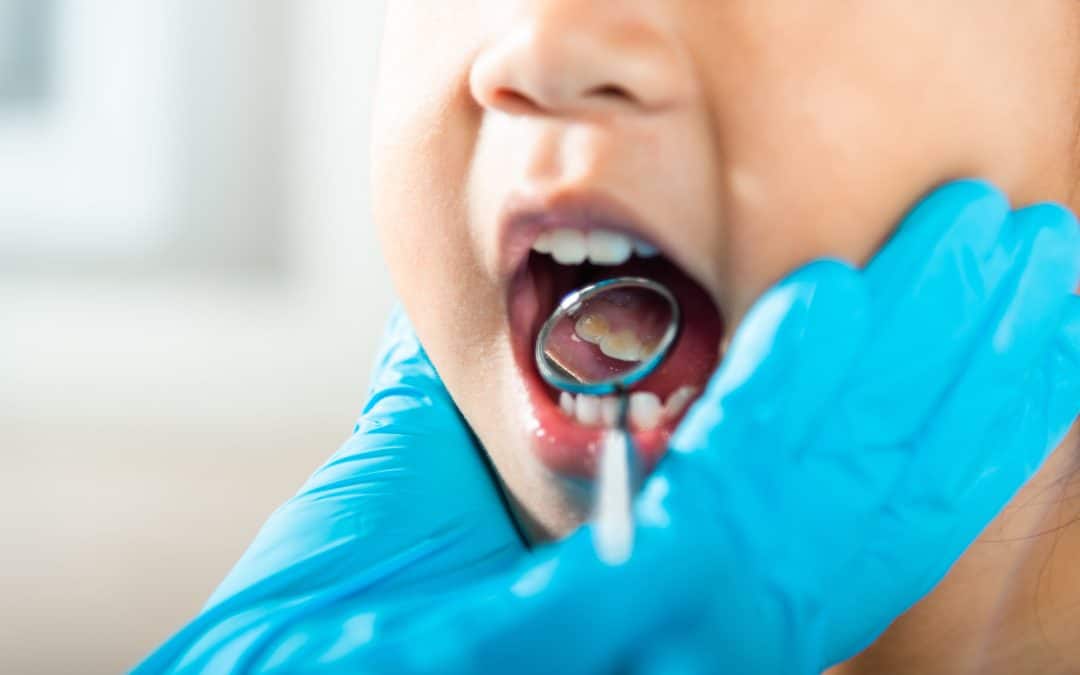 Should Decayed Baby Teeth Be Removed?